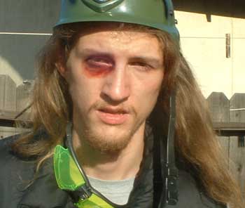 high_impact_paintball_black_eye.jpg